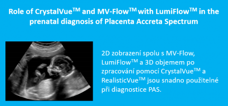 CrystalVueTM & MV-FlowTM pro vyšetření placenty